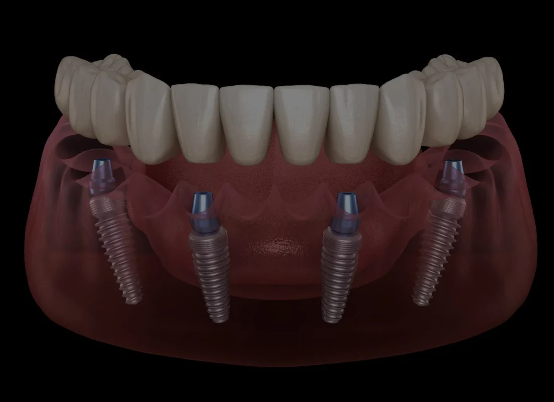 Y a-t-il des barrières linguistiques pour recevoir des soins dentaires en Turquie ? Avantages de la procédure All-on-Four Implants Est-il sécuritaire d'obtenir des soins dentaires en Turquie Combien coûte All on 4 Dental Implants en Turquie ? Combien de temps durent généralement les procédures dentaires en Turquie ? Comment sont appliqués tous les 4 implants dentaires en Turquie Implant Dentaire Prix